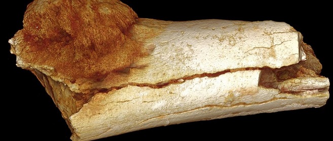 Earliest case of cancer has been found in 1.7 million-year-old bone